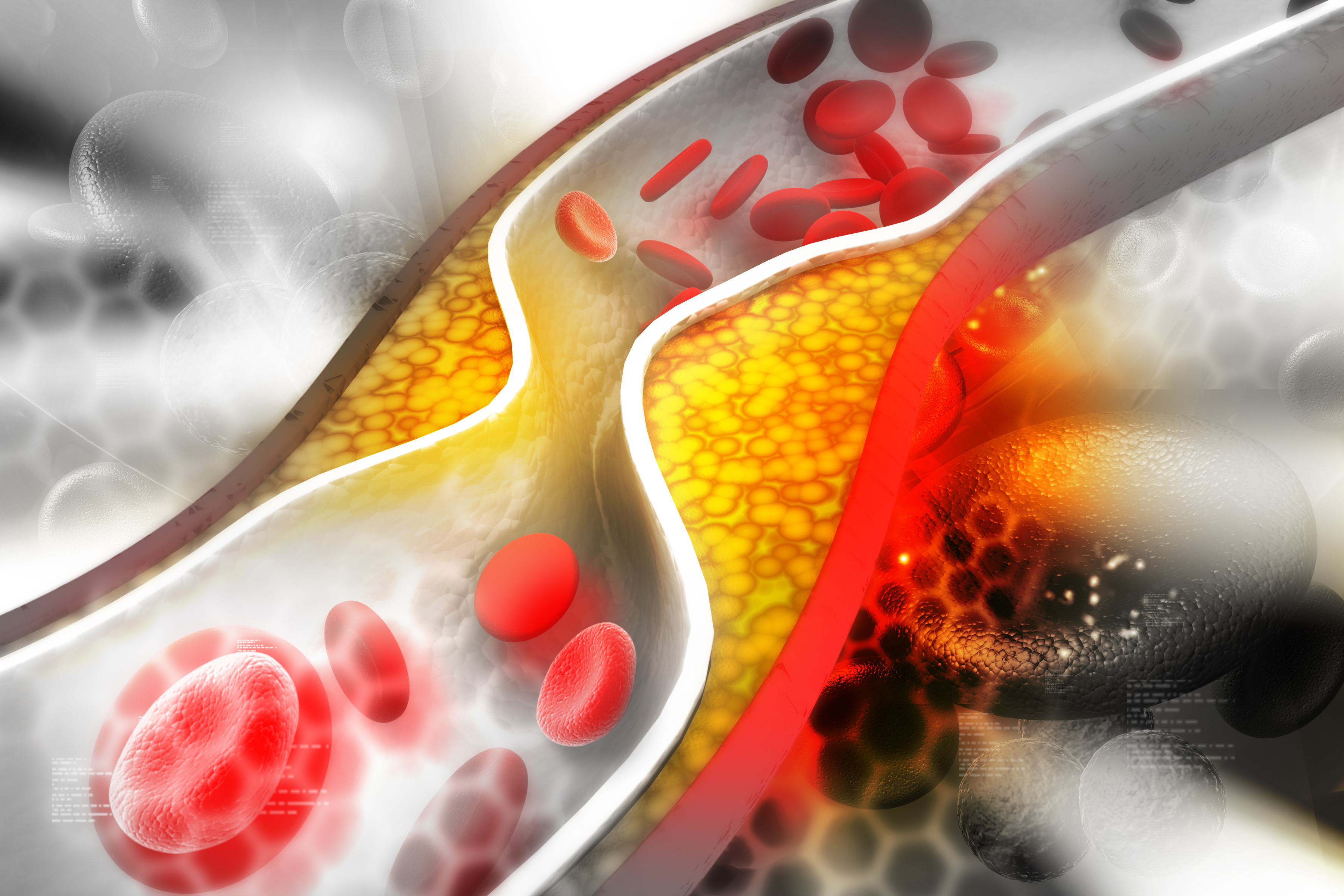 A visual showing build up of cholesterol in the body