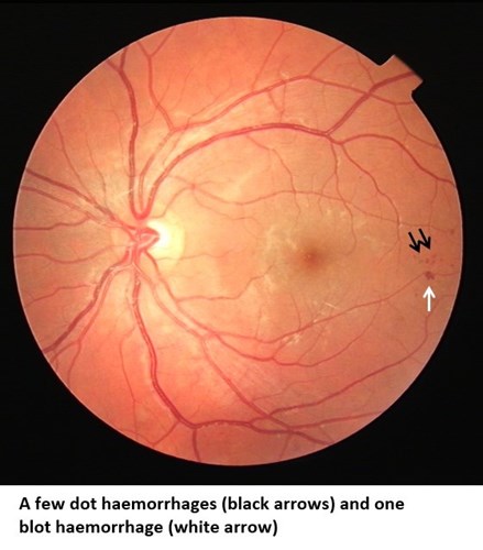Details 300 background diabetic retinopathy