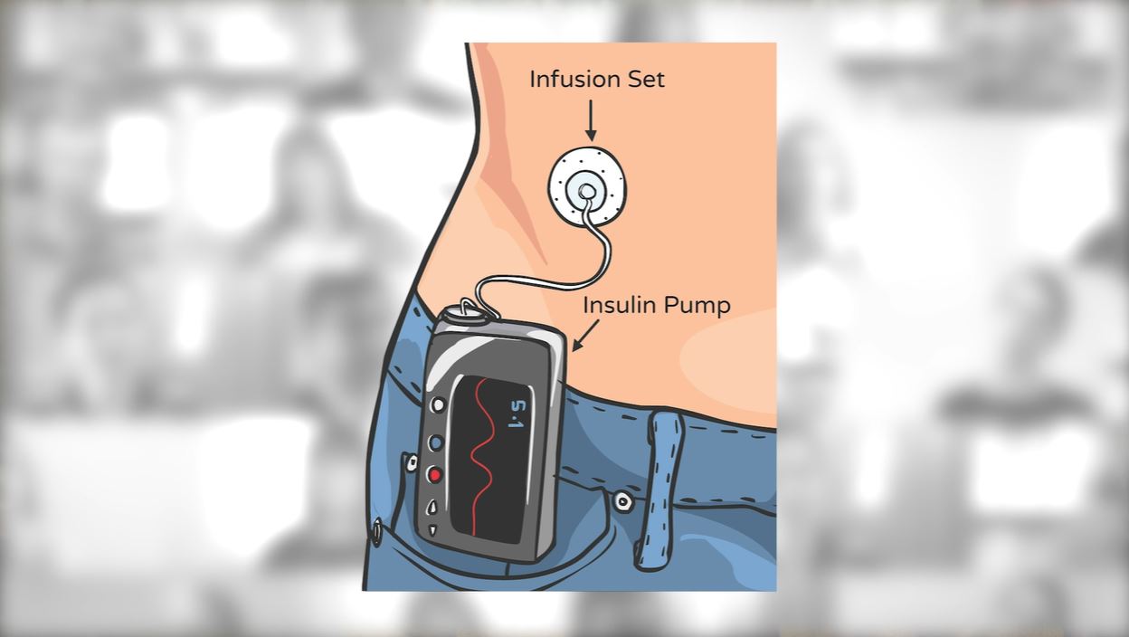 Type 1 diabetes Know Diabetes